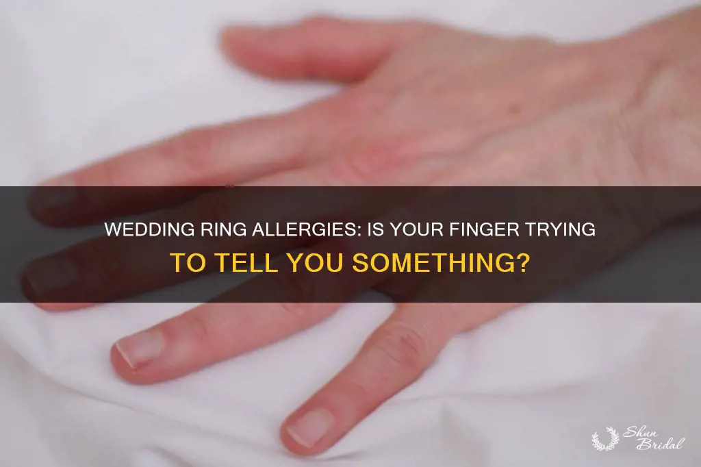 can I be allergic to my wedding ring