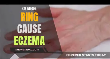 Wedding Ring Eczema: Is Your Ring Causing Skin Irritation?