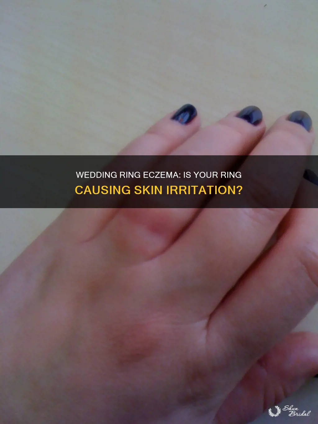 can wedding ring cause eczema