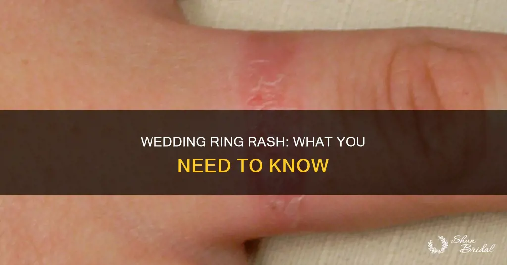 can wedding ring rash spread