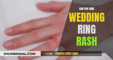 Wedding Ring Rash: Can It Be Cured?