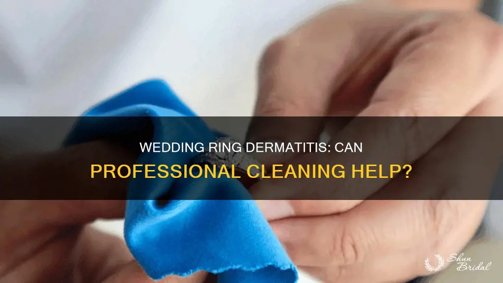 does professional cleaning help with wedding ring dermatitis
