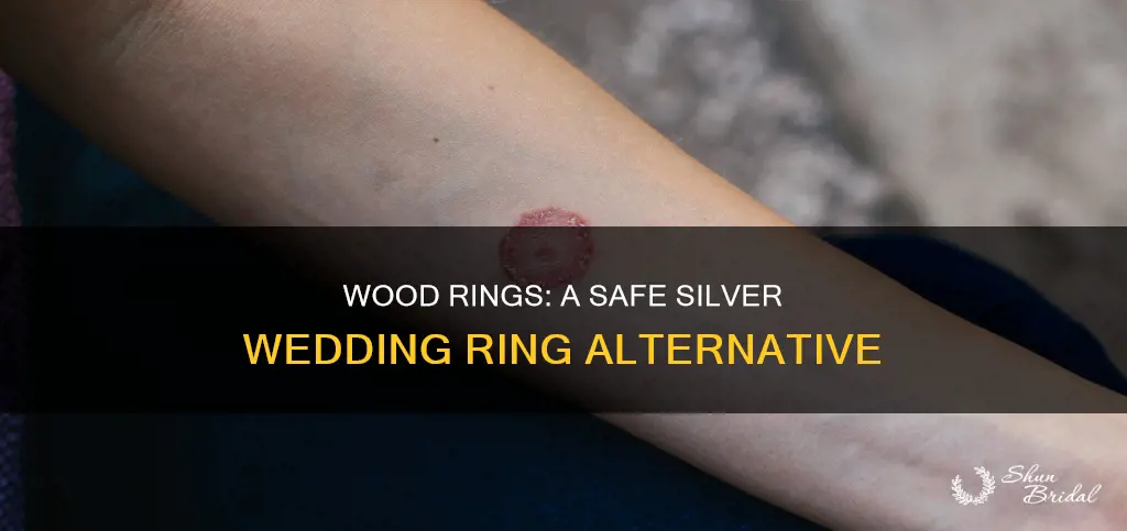 does wood ring silver wedding ring dermatitis