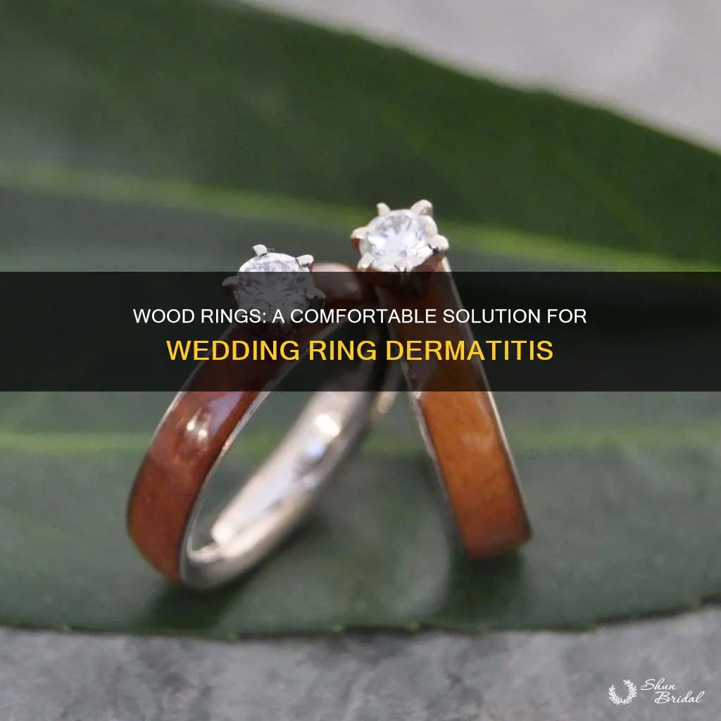 does wood ring solve wedding ring dermatisis