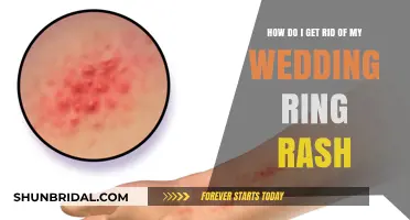 Wedding Ring Rash: Relief and Prevention Tips