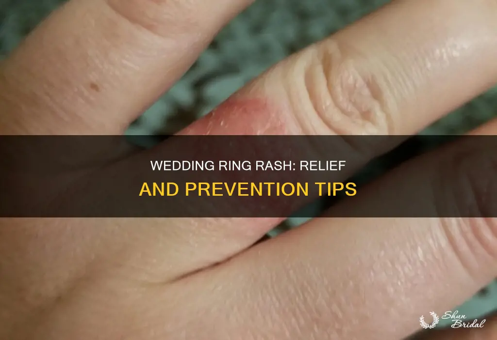 how do I get rid of my wedding ring rash