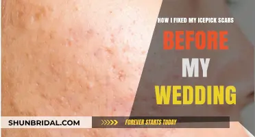 Transforming My Skin: Healing Icepick Scars Before My Wedding Day