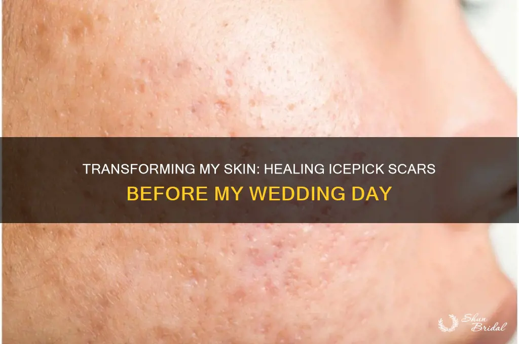 how I fixed my icepick scars before my wedding