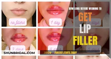 Lip Fillers for Your Wedding: How Far in Advance?