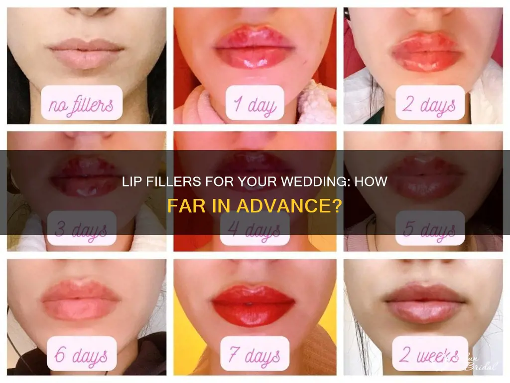 how long before wedding to get lip filler