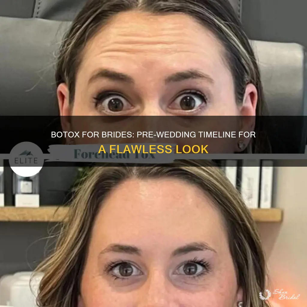 how long to get botox before wedding