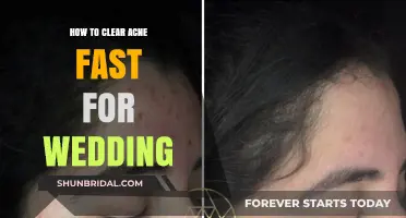 Quick Wedding Acne Solutions: Clear Skin Fast for Your Big Day