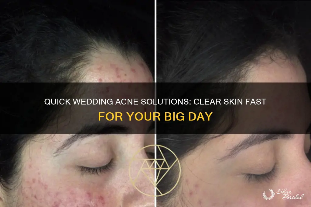 how to clear acne fast for wedding