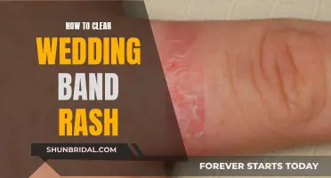 Wedding Band Rash: Quick Fixes