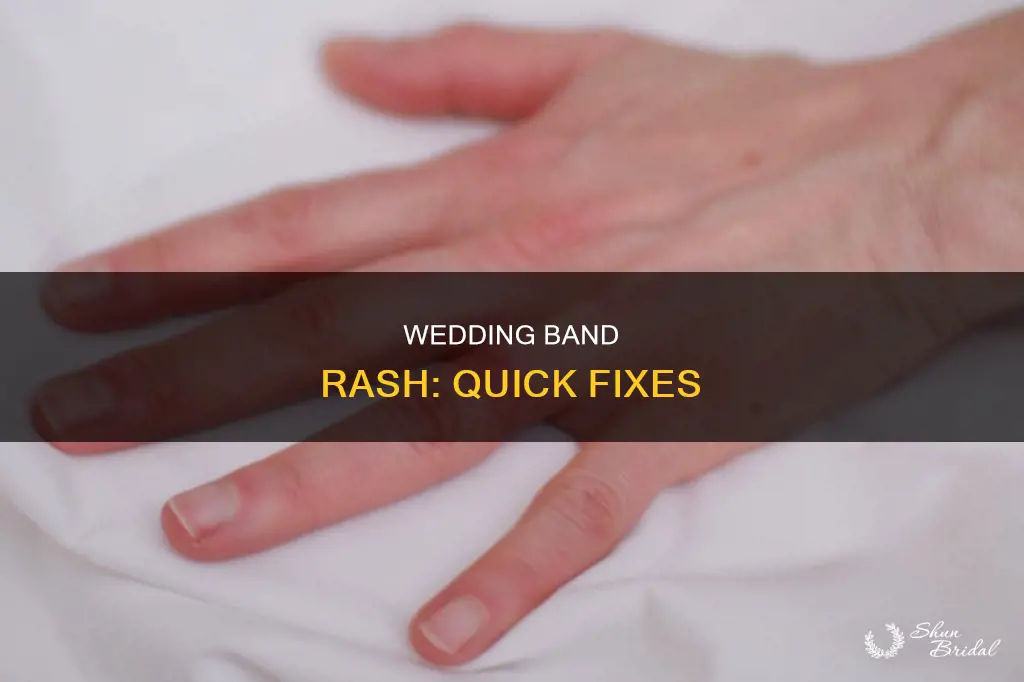 how to clear wedding band rash