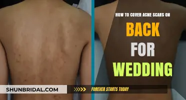 Flawless Wedding Skin: Concealing Back Acne Scars for Your Big Day