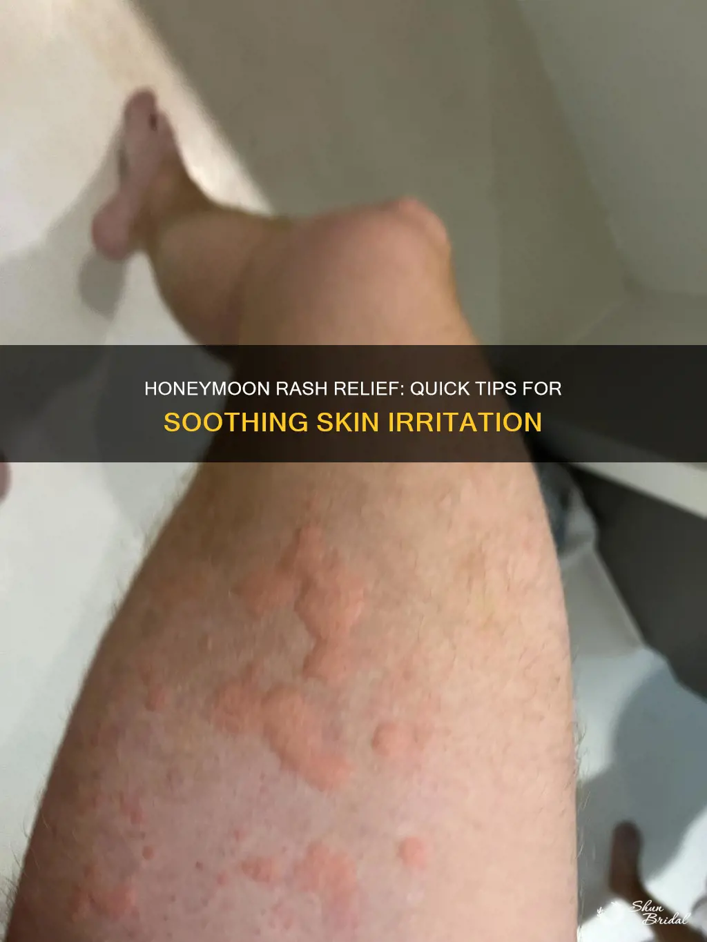 how to cure honeymoon rash