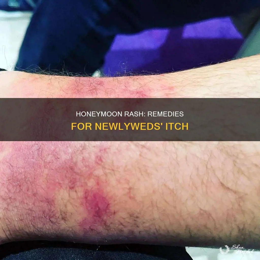 how to cure honeymoon rash