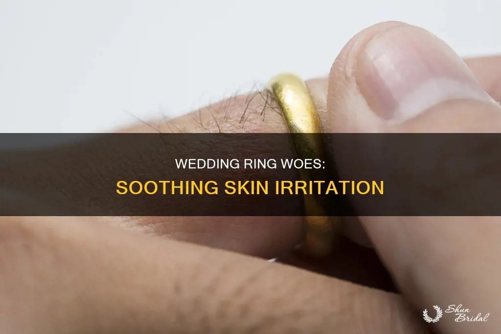 how to doctor an irritation under golden wedding band