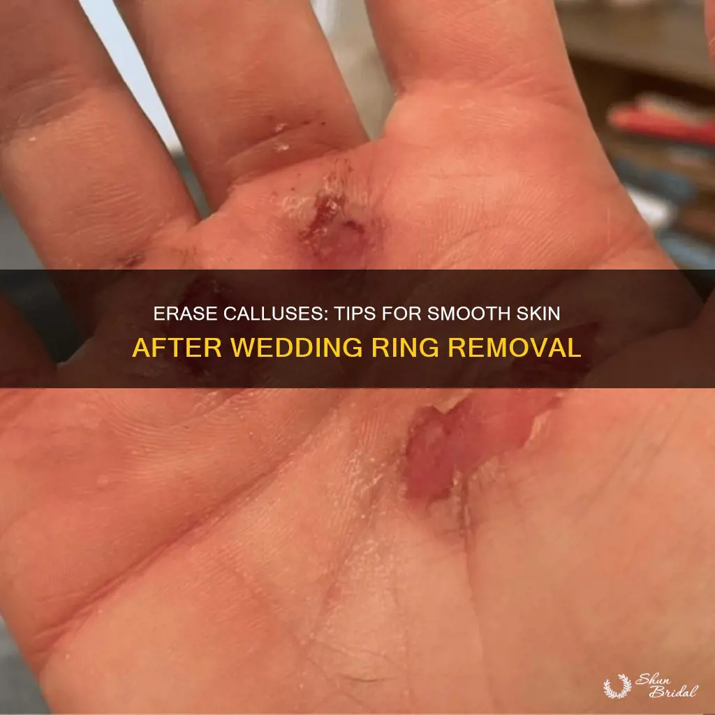how to get rid of wedding ring callus
