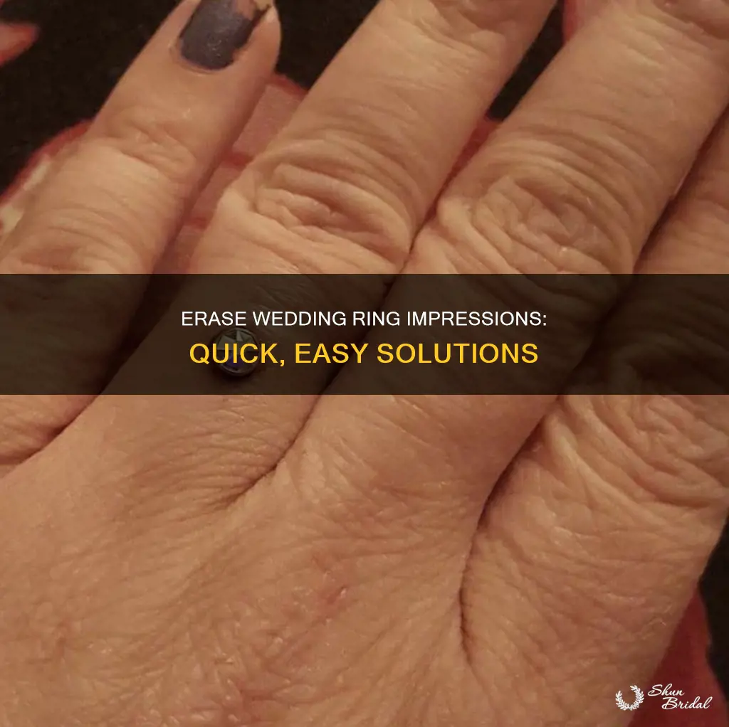 how to get rid of wedding ring impression