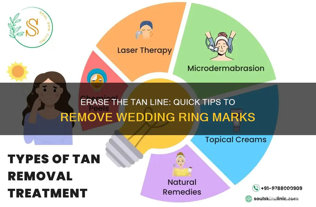 how to get rid of wedding ring line