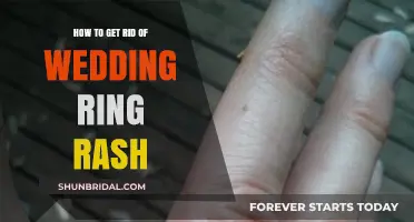 Treating Wedding Ring Rash: Quick and Easy Solutions