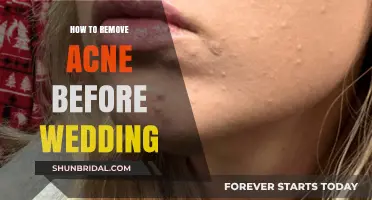 Clear Skin for Your Big Day: Quick Wedding Acne Removal Tips