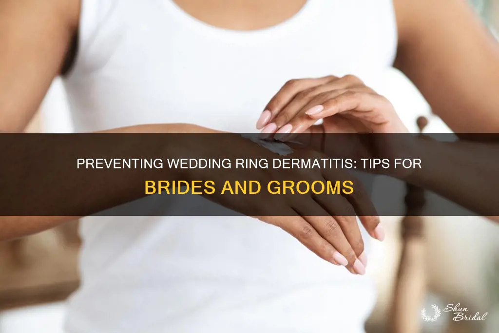 how to stop wedding ring dermatitis