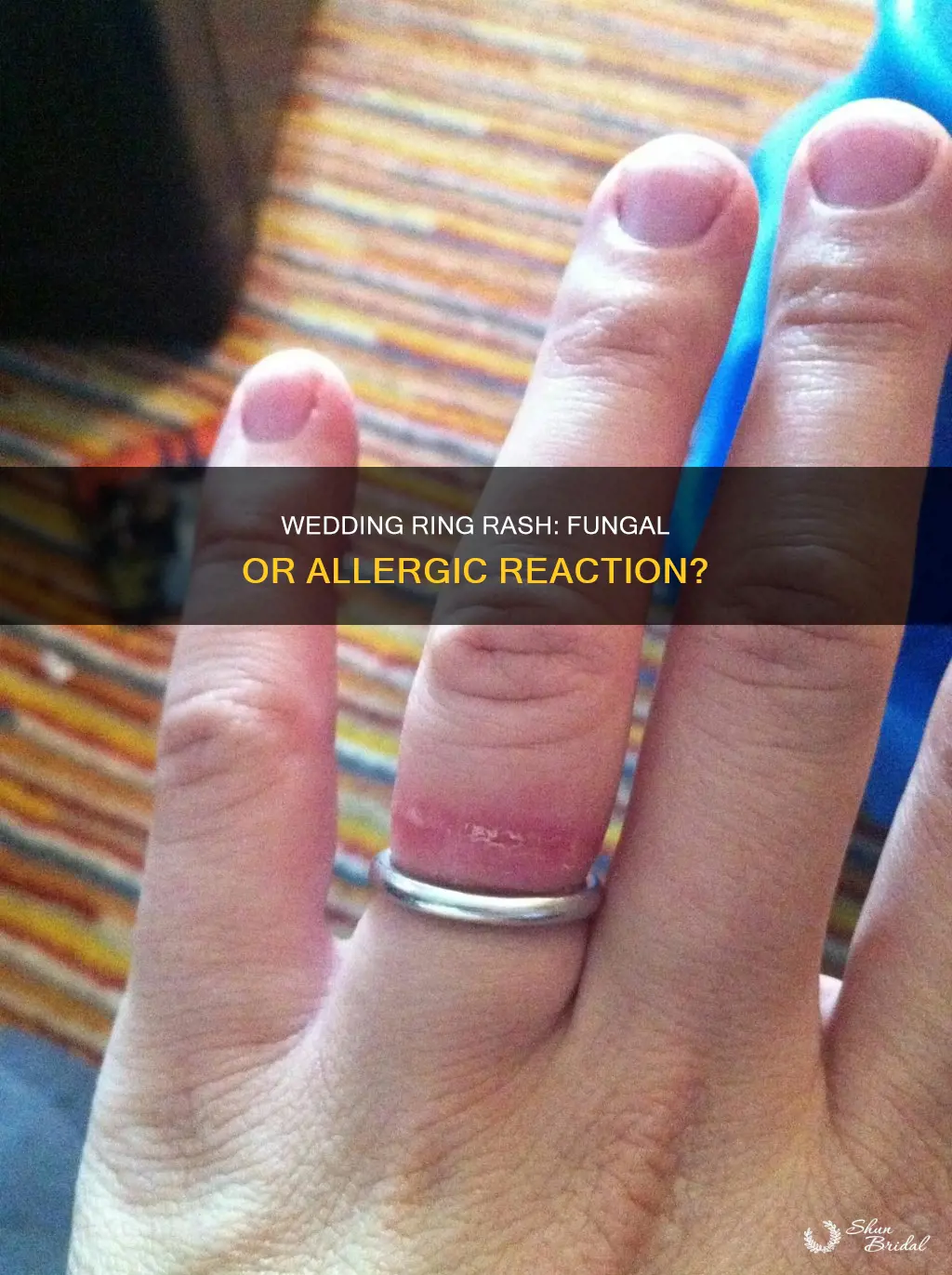 is wedding ring rash a fungus