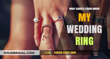 Wedding Ring Rashes: What's the Cause?