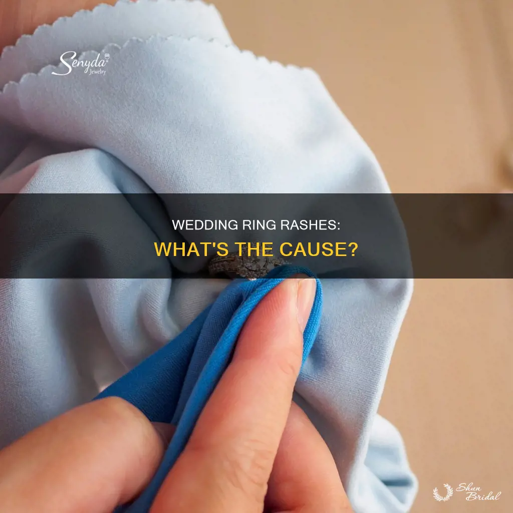 what causes a rash under my wedding ring