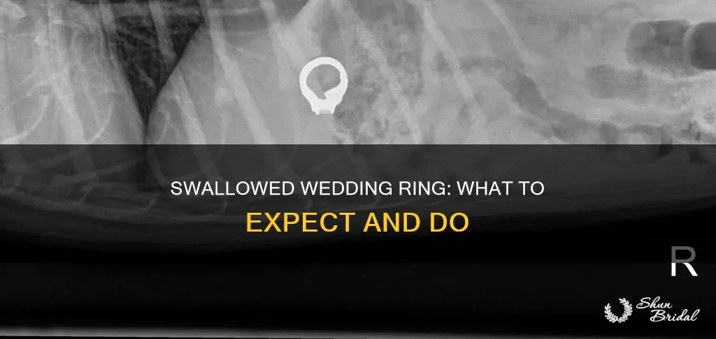 what happens if you swallow a wedding ring