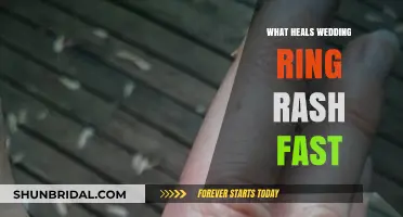 Healing Wedding Ring Rash: Quick and Easy Solutions