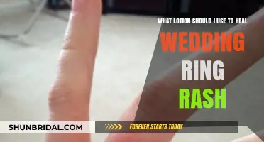 Healing Wedding Ring Rash: Choosing the Right Lotion