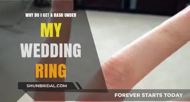 Wedding Ring Rashes: What's the Cause?