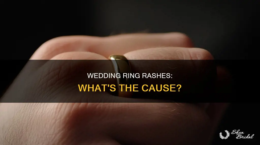 why do I get a rash under my wedding ring