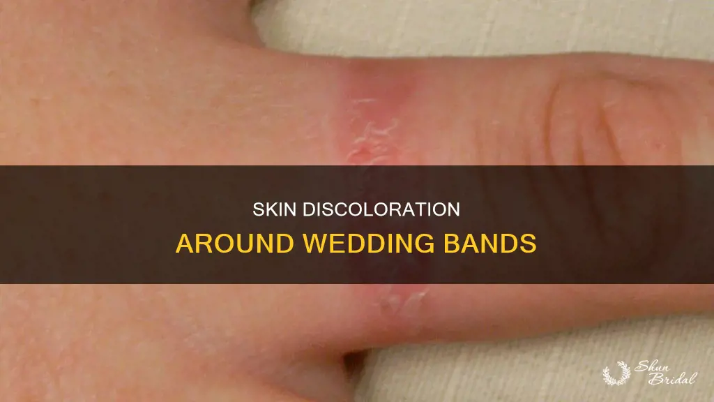 why does my skin turn black around.my wedding band