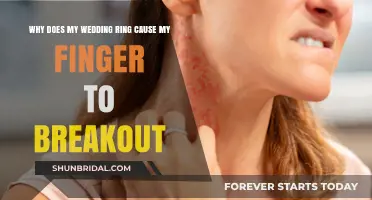 Wedding Ring Woes: Finger Breakout Blues
