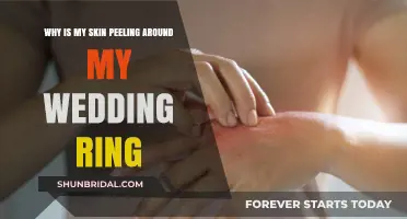 Skin Peeling Around Your Wedding Ring: What's the Cause?
