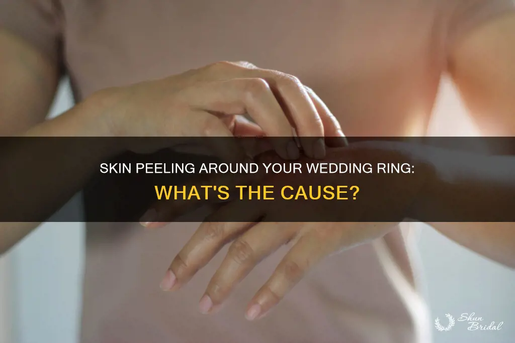 why is my skin peeling around my wedding ring