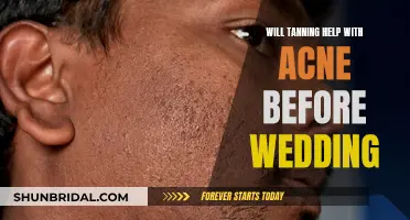 Tanning and Acne: Pre-Wedding Skin Care Tips