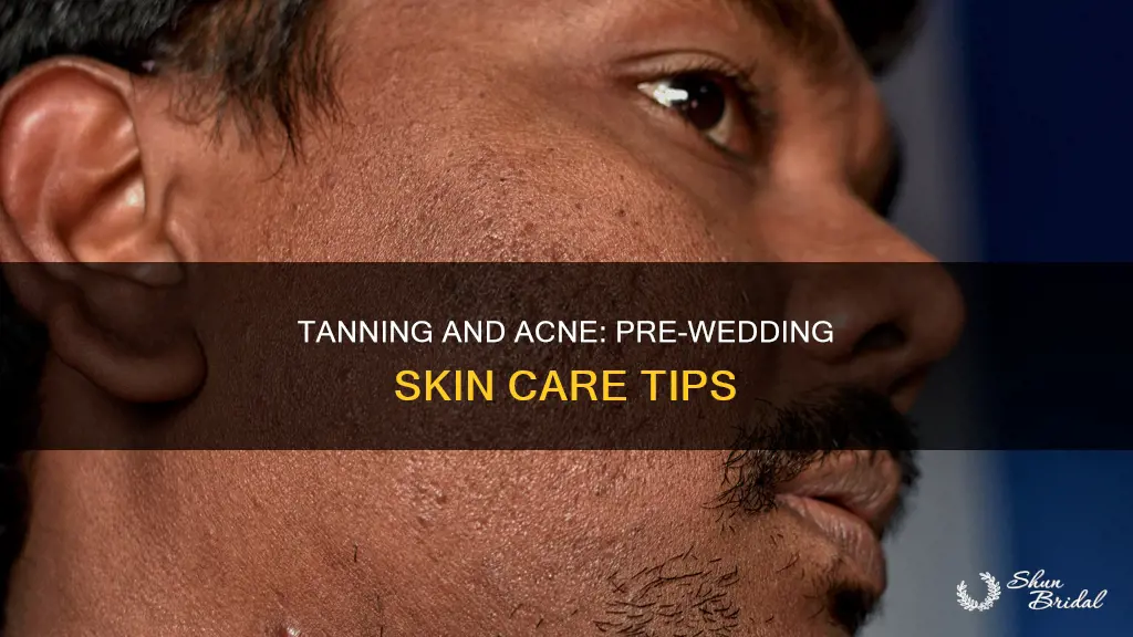 will tanning help with acne before wedding